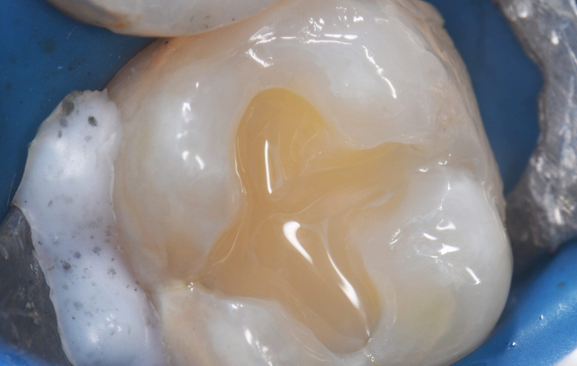 composite dents