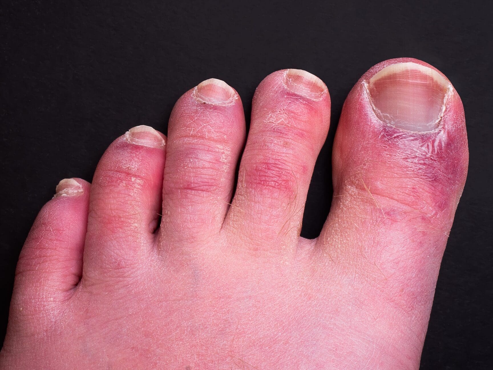Papules aux pieds : Causes, traitements et préventions