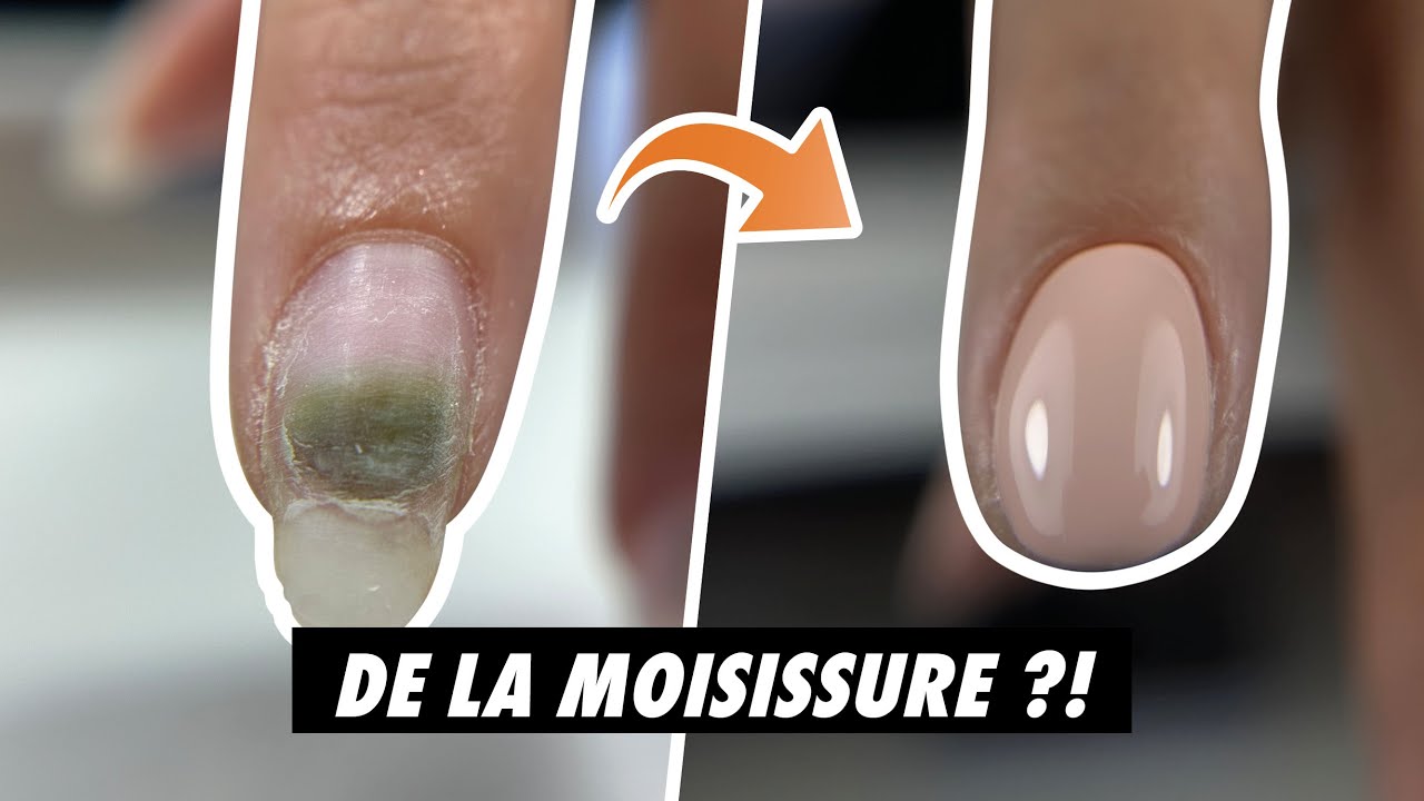 Tache verte d'une infiltration de l'ongle visible sous la lame unguéale