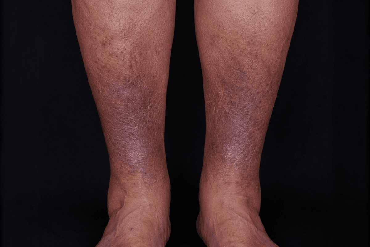 Pigmentation brune de dermite ocre sur la jambe autour de la cheville