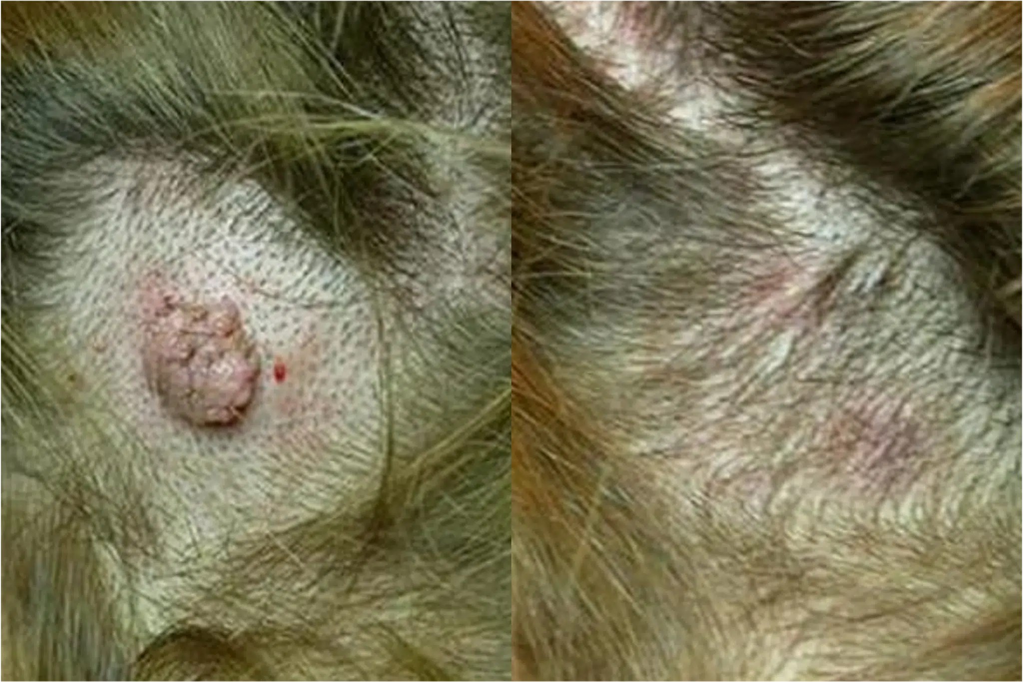 Grain de beauté du cuir chevelu examiné à la dermoscopie, cheveux écartés autour du naevus