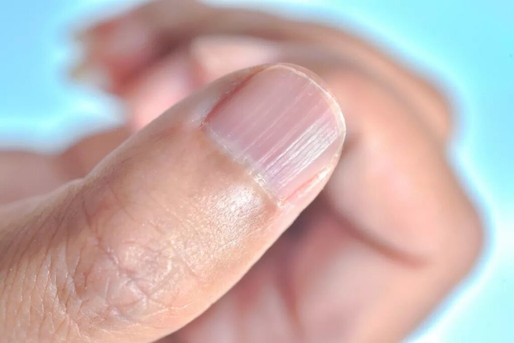 Ongle de main qui se d&eacute;double &agrave; son extr&eacute;mit&eacute; libre, aspect fin et stri&eacute;
