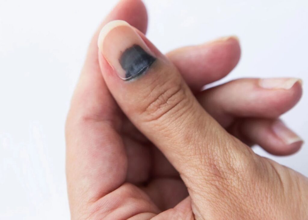 Ongle noir d'un doigt de la main avec un h&eacute;matome sous-ungu&eacute;al visible pr&egrave;s de la cuticule