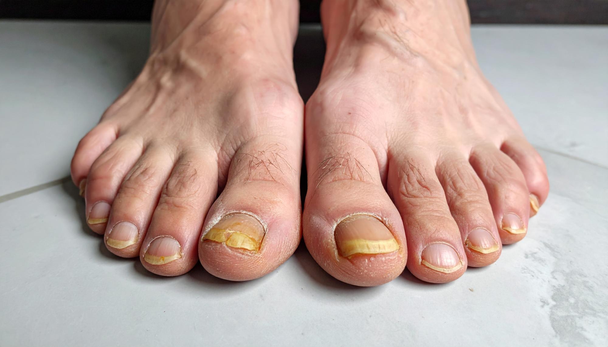 Gros plan d'un ongle de pied présentant une coloration jaune
