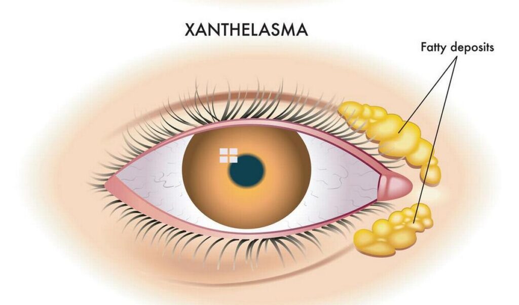 Plaques jaunâtres de xanthelasma près de l'angle interne des paupières