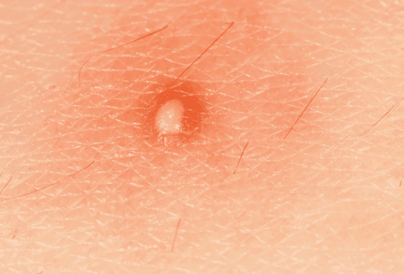 Furoncle percé laissant un petit trou rouge au centre d'une zone de peau inflammée