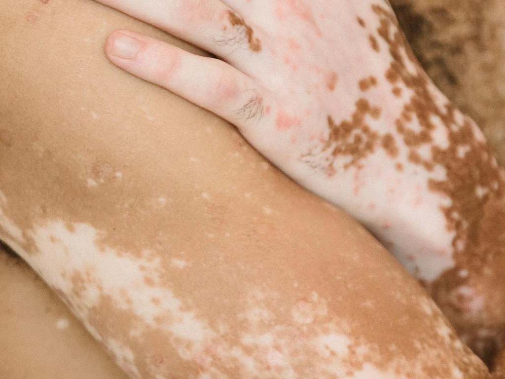Taches claires de pityriasis versicolor sur le dos en cours de repigmentation