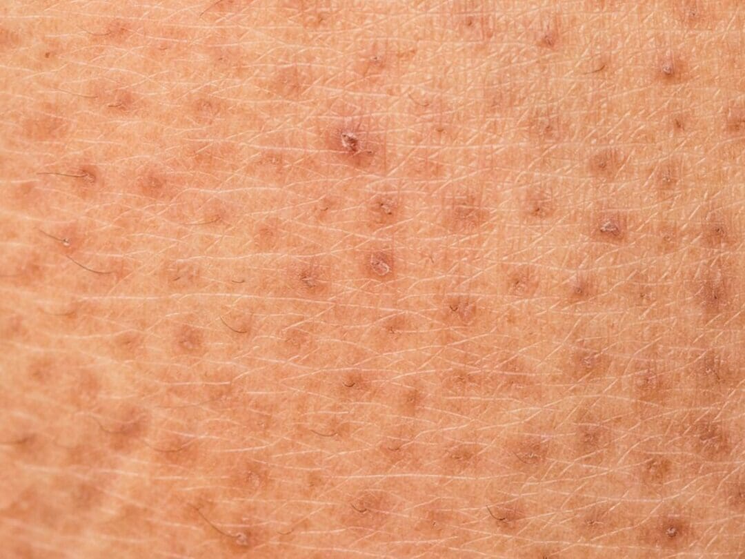 Sarcoidose Cutanée: Comprendre la Maladie à travers le Prisme des Images